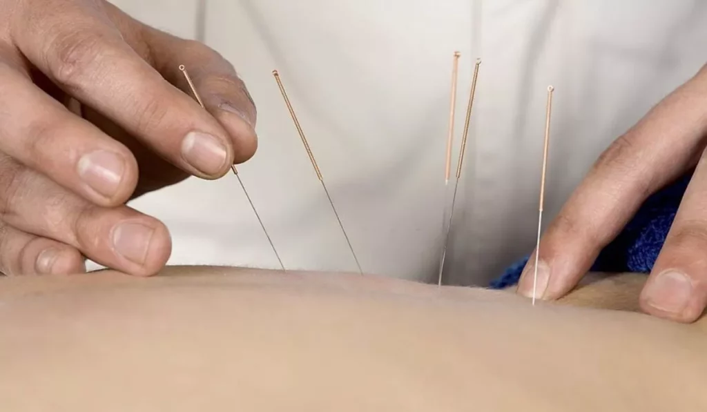 Acupuncture An Effective Approach To Nerve Damage